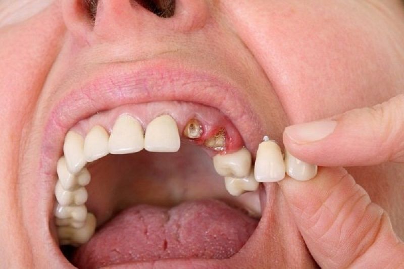 Nằm mơ thấy rụng răng không chảy máu