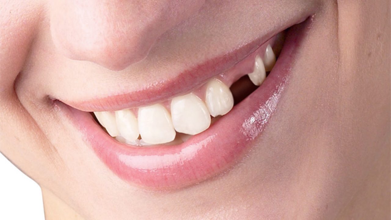 Nằm mơ thấy rụng răng giả
